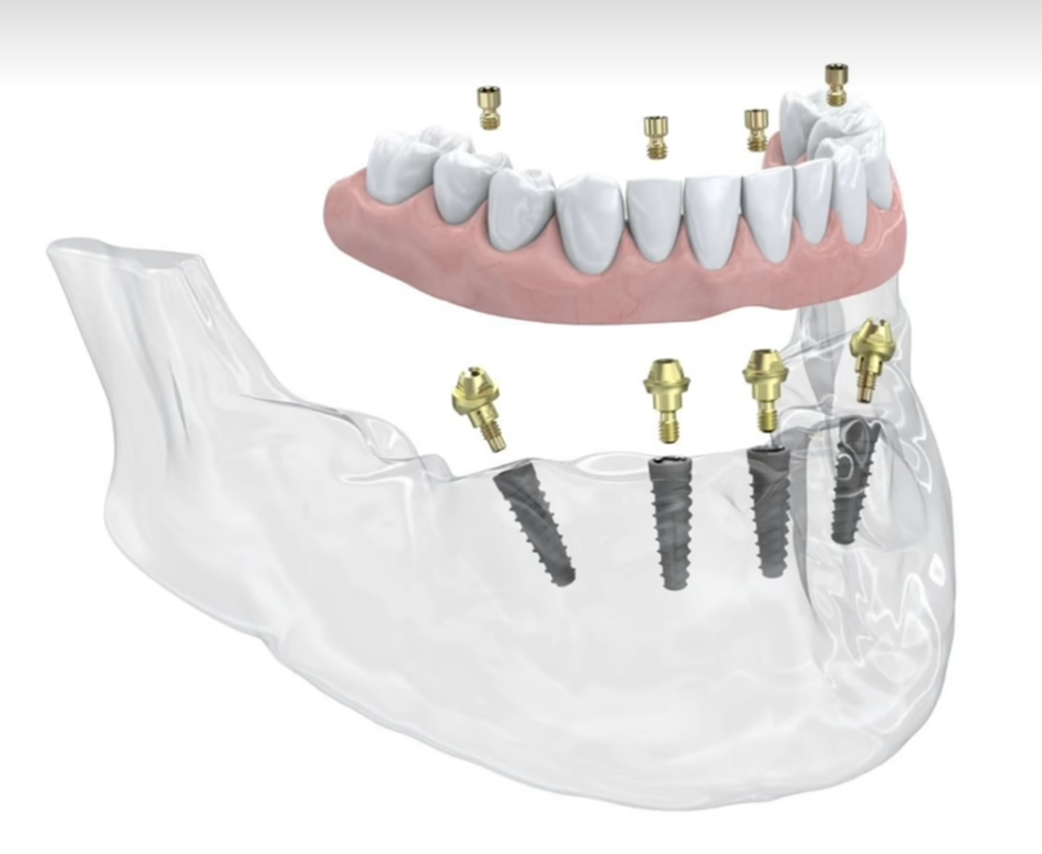 graceful Dental Implant
